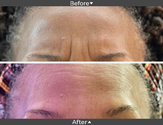Botox for forehead wrinkles.