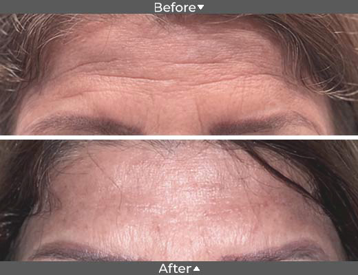 Botox for forehead wrinkles.