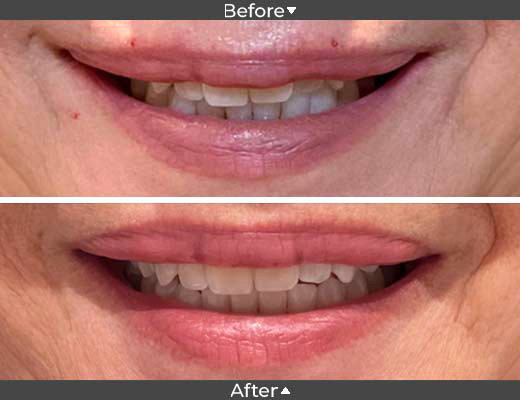 Botox for wrinkles around lips.