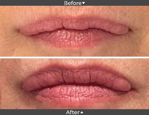 Botox for wrinkles around lips.