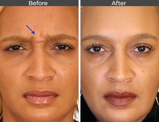 https://assileye.cachefly.net/Plugin/AEI-Before%26After/Image/Thumb/Botox/Botox-Before-and-After-JN01.jpg