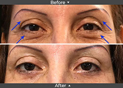 Blepharoplasty Before & After Pictures