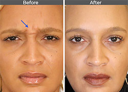 Botox Before and After Images
