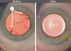 Cataract Before and After Images