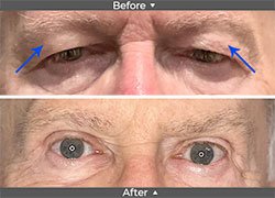 Eyelid Ptosis Before and After Pictures