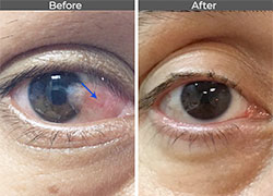 Pterygium Before and After Pictures
