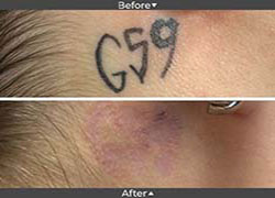 Before and AFter Tattoo Removal Image
