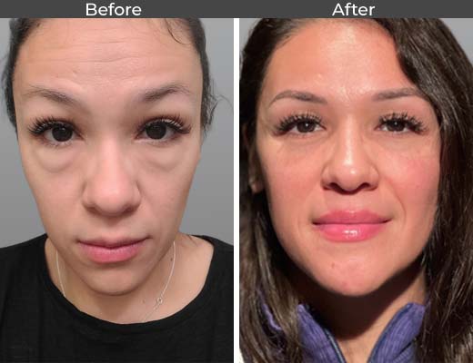 Lower Lid Blepharoplasty