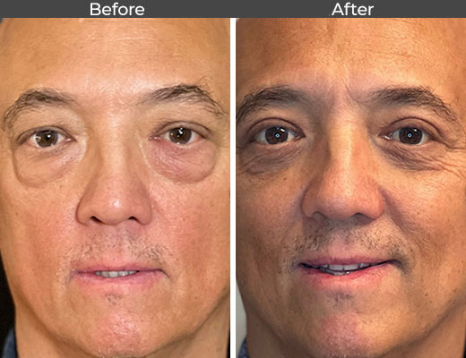 Upper with Lower Lid Blepharoplasty Before and After Pictures