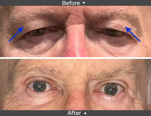 Upper Lid Blepharoplasty