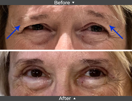 Upper Lid Blepharoplasty