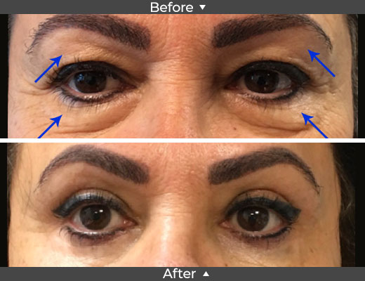 Upper and Lower Blepharoplasty Before and after Images