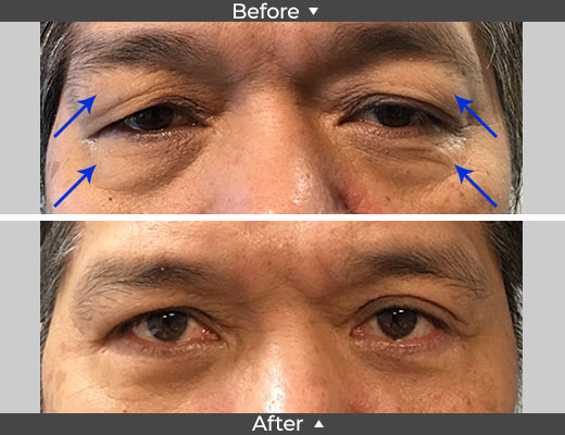 Upper and Lower Blepharoplasty Before and After Surgery Pictures