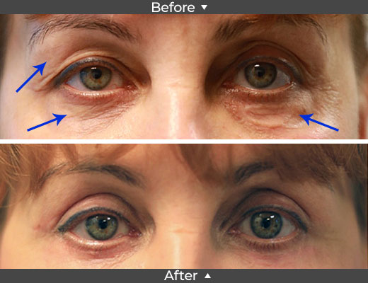 Upper and Lower Blepharoplasty and Scar Excision Surgery Pictures