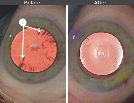 Cataract patient before and after picture number 1