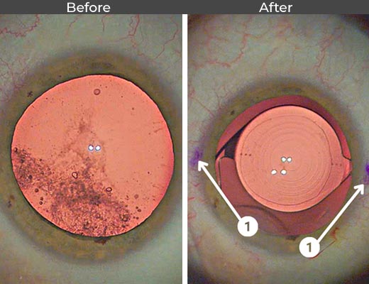 Cataract patient before and after picture number 11