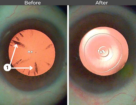 Cataract patient before and after picture number 14