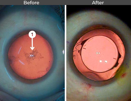 Cataract patient before and after picture number 18