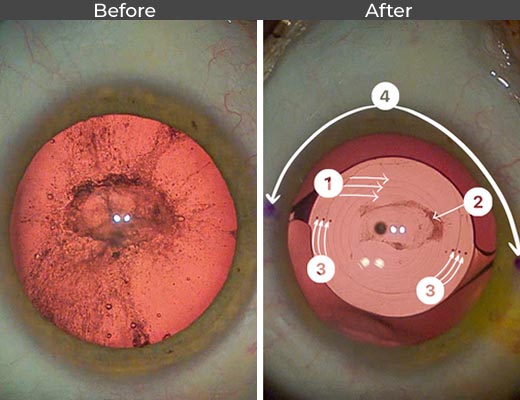 Cataract patient before and after picture number 20