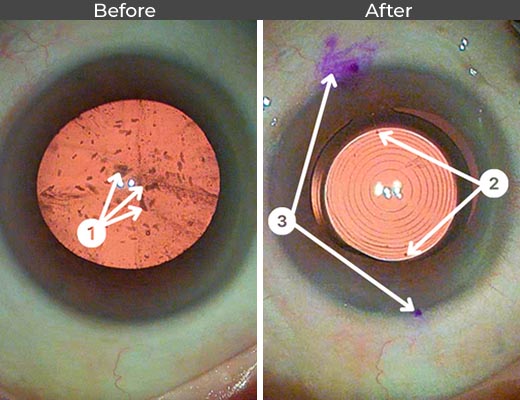 Cataract patient before and after picture number 28