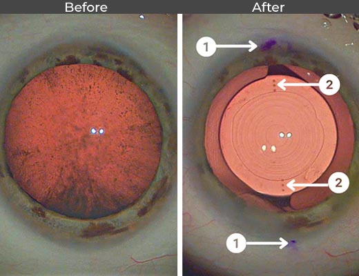Cataract patient before and after picture number 8