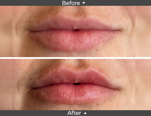 Eva Filler Lip Enhancement Before and After Image