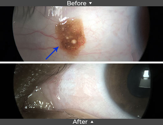 Nevus Removal