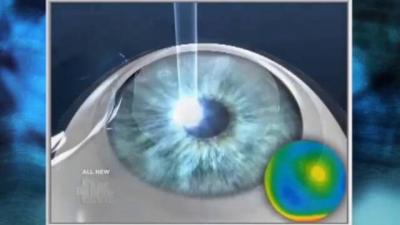 Does LASIK Surgery wear off?