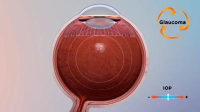 OMNI 360 For Glaucoma