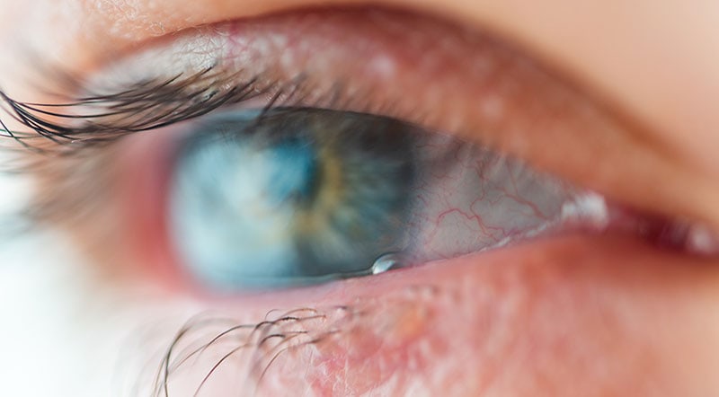 What is ocular herpes?