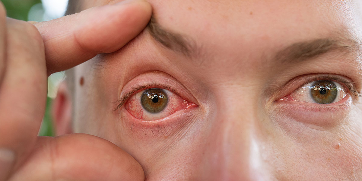 Why is My Iris Inflamed? When to See a Doctor for Iritis