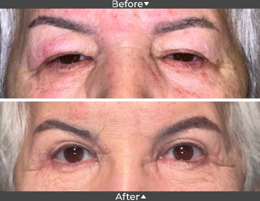 Blepharoplasty Before and After Image, Assil Gaur Eye Institute Los Angeles