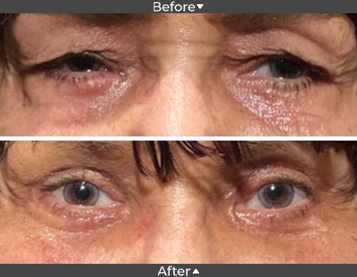 Blepharoplasty Before and After Image, Assil Gaur Eye Institute Los Angeles