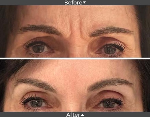 Botox before and after image, AGEI Los angeles