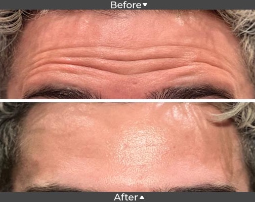 Botox on forehead before and after image