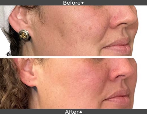 Cosmelan peel, Before and after Picture