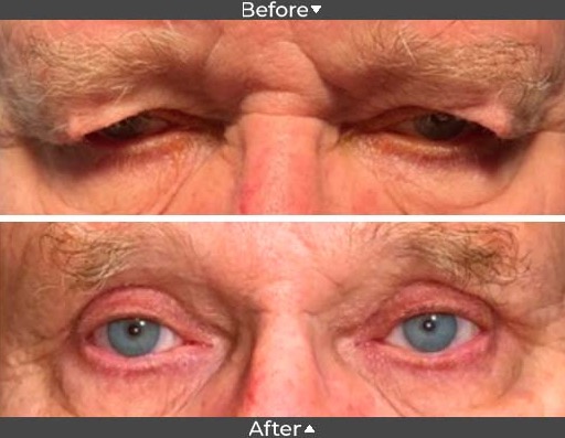 ptosis before and after pictures, Assil Gaur Eye Institute