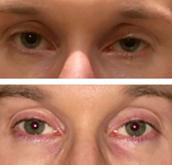 Ptosis  for saggy eyes, Assil Gaur Eye Institute of Los Angels