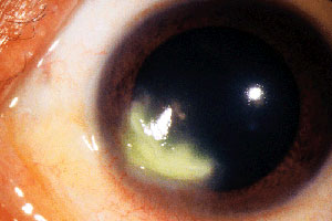 Keratitis - Corneal Ulcer