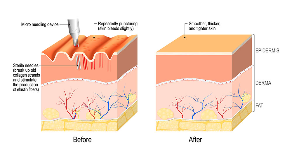 Microneedling, Assil Eye Instute