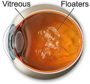 Eye floaters, Assil Gaur Eye Institute