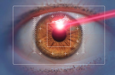 LASIK laser surgery evolution