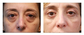 Blepharoplasty