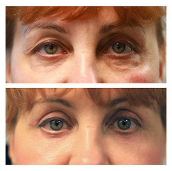 Blepharoplasty