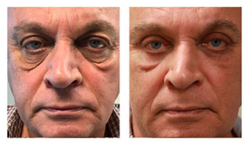 Blepharoplasty