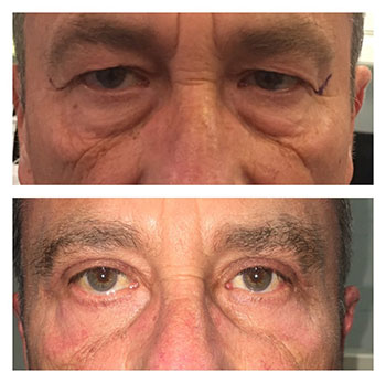 Blepharoplasty