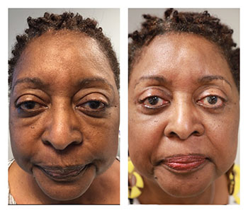 Blepharoplasty